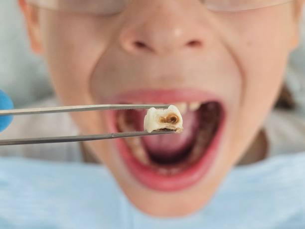 Best Broken or Cracked Tooth Emergency Dentist in Williamson, WV